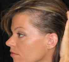 Razlozi koji su izazivali difuzni gubitak kose i načine kako ih eliminirati